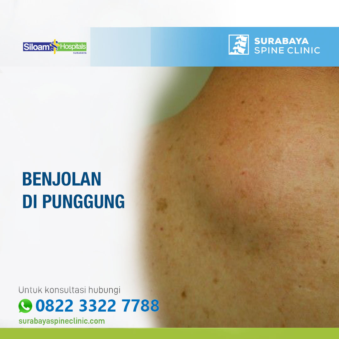 Benjolan di Punggung: Penyebab, Diagnosis, dan Penanganan yang Tepat